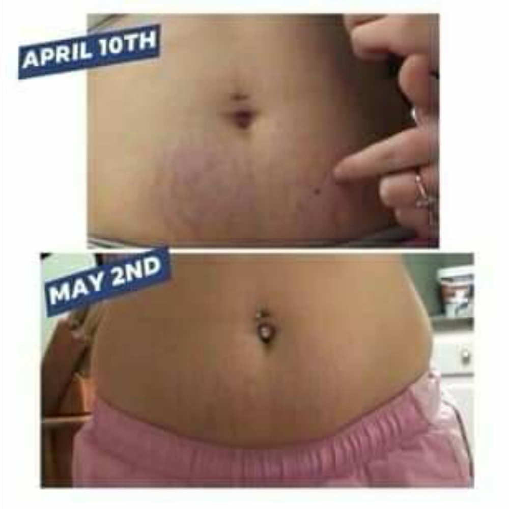 PREORDER ONLY ByeBye Stretch Marks,Mosquitos,Burns - Picture 12 of 16